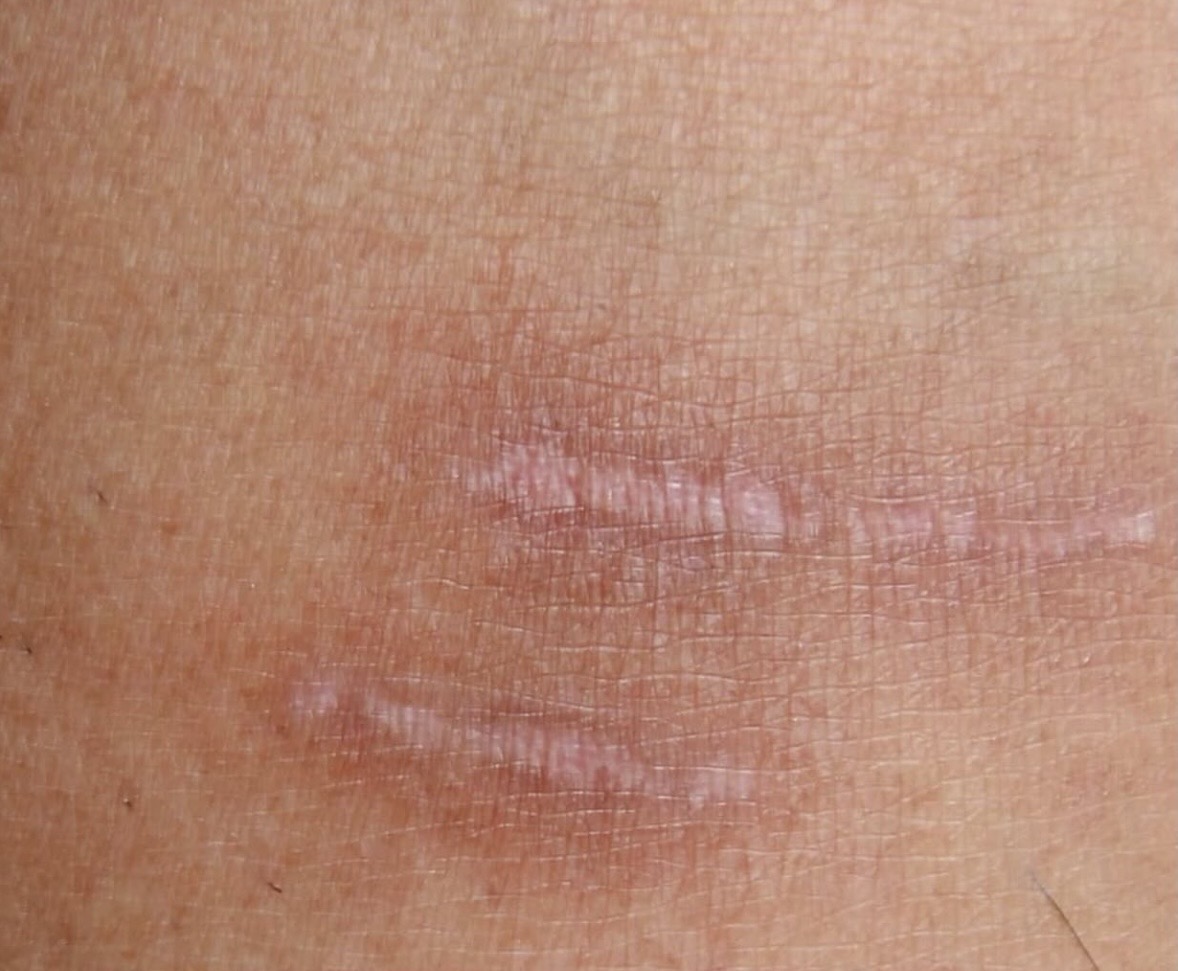 Close-up of a mature, healed scar — the type of skin candidate ideal for scar camouflage tattooing